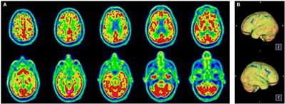 Case Report: Behavioral Unresponsiveness in Acute COVID-19 Patients: The Utility of the Motor Behavior Tool-Revised and 18F-FDG PET/CT